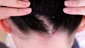 Kako hitro odstraniti uši in gnile doma