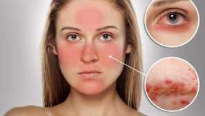 Podkožni simptomi, zdravljenje in preprečevanje!